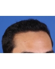 After Hair Transplant&nbsp;Front